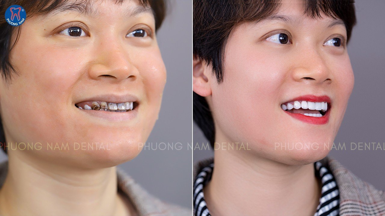 Nụ cười sau khi được tái tạo tại Nha khoa Phương Nam
