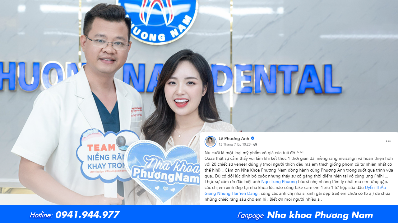 Chị Lê Phương Anh và hành trình 2 năm niềng răng Invisalign kết hợp với dán sứ Veneer