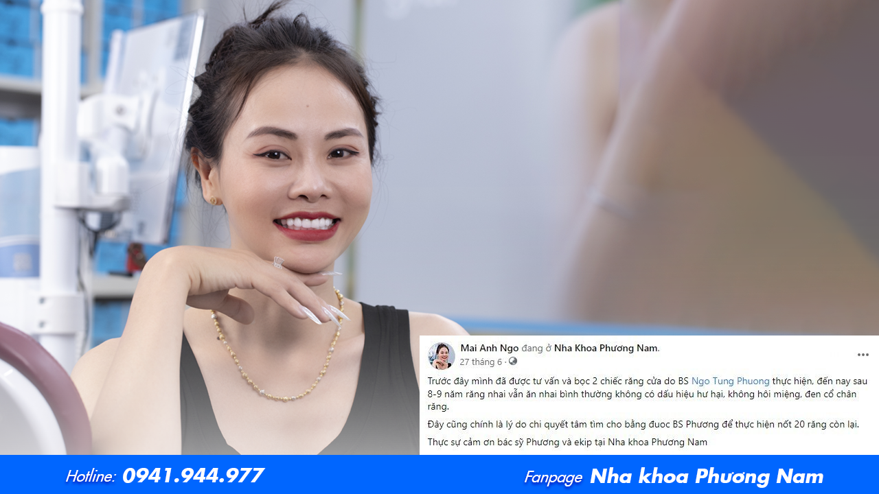 Chị Mai Anh Ngô đã tin tưởng và quay trở lại Nha khoa Phương Hoa để thực hiện làm 20 răng sứ
