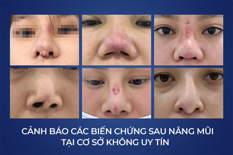 Hàng loạt các biến chứng nguy hiểm sau nâng mũi tại các cơ sở không uy tín