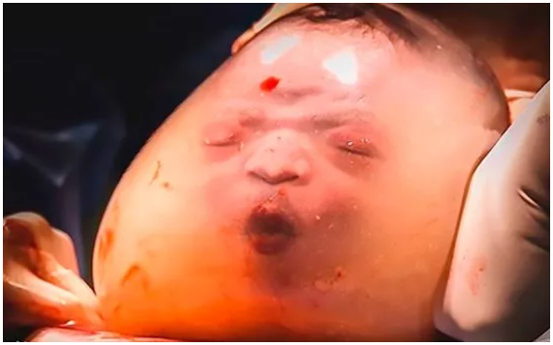 Có một vài trường hợp em bé sinh ra vẫn còn nguyên trong bọc nước ối. 
