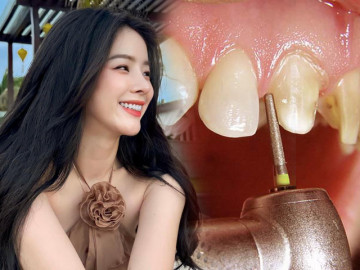 Hotgirl chà đĩa xinh nhất Đà Nẵng hối hận không kịp vì làm răng sứ
