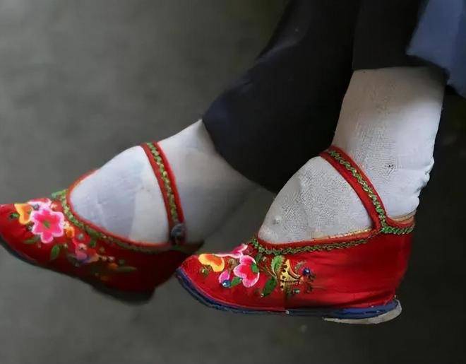 Tục bó chân biến phụ nữ từ khỏe mạnh thành một người bị biến dạng, khuyết tật chân. (Ảnh minh họa)