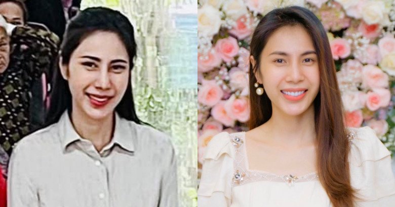 View - Ca sĩ Thủy Tiên vướng nghi vấn dao kéo vì 2 điểm khác lạ trên gương mặt, bị nói tâm sinh tướng