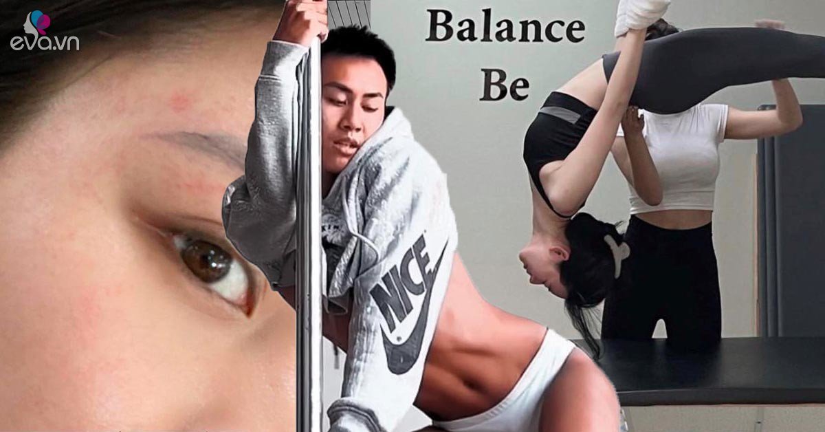 View - Lộn ngược tập Pilates và Pole Dance giữ dáng, nàng mẫu Sài thành gặp hiện tượng lạ trên da, chuyên gia lên tiếng