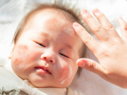 Làm mẹ - Tháng 9 giao mùa và nỗi lo con dị ứng da do thời tiết của mẹ bỉm