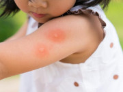 Làm mẹ - Những vấn đề về da thường gặp ở trẻ mùa tựu trường