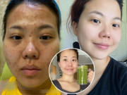 Làm đẹp - Không ăn sáng mà "bơm" vitamin với loại nước này, cô gái mặt mụn, da ngăm trẻ ra chục tuổi