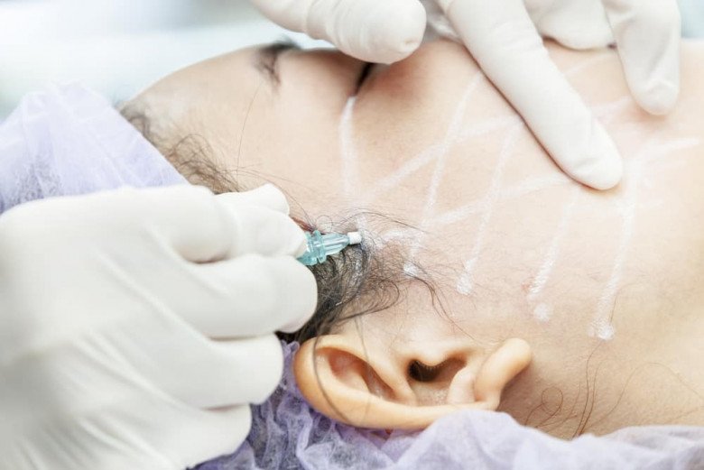 Căng da bằng phương pháp căng chỉ nâng cơ là một tiểu phẫu, không xâm lấn nên được nhiều người lựa chọn trong thời gian gần đây.