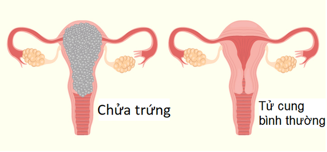 Chửa trứng có gây ung thư không? - 1