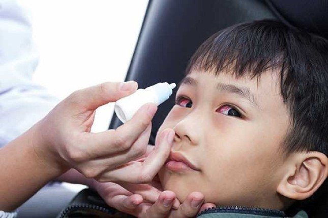 Người bị đau mắt đỏ không nên tự ý sử dụng thuốc nhỏ mắt có chứa corticoid. (Ảnh minh họa)