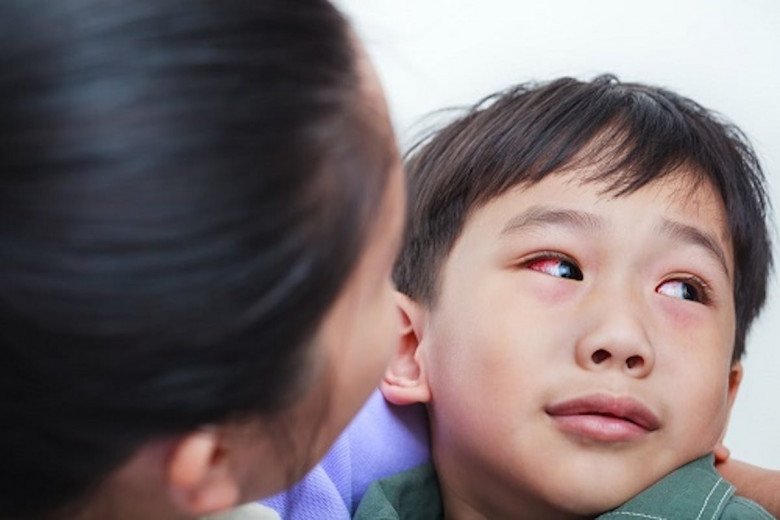 Bệnh đau mắt đỏ không lây lan qua con đường uống nước. (Ảnh minh họa)