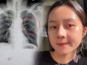 Làm đẹp - Chuyện hy hữu, cô gái ho gãy xương sườn vì kem chống nắng, sự thật ra sao?