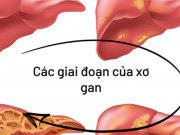 Sức khỏe - Cơ thể có 6 dấu hiệu này chứng tỏ gan của bạn đang nhiễm bệnh, cần khám gan càng sớm càng tốt!