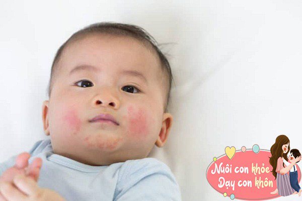 Nguyên nhân của bệnh chàm ở trẻ rất phức tạp, bao gồm dị ứng thức ăn, dị ứng môi trường, nhiễm trùng và rối loạn chức năng bảo vệ da.