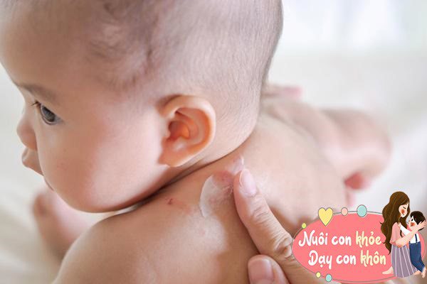 Nếu trẻ bị rôm sảy, cha mẹ có thể sử dụng bột chữa rôm sảy để giảm các triệu chứng.