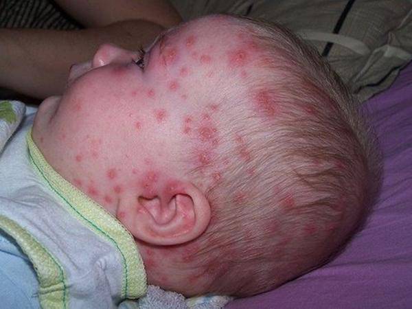 Hình ảnh bệnh thủy đậu ở trẻ em, cha mẹ cần biết để điều trị hiệu quả - 1