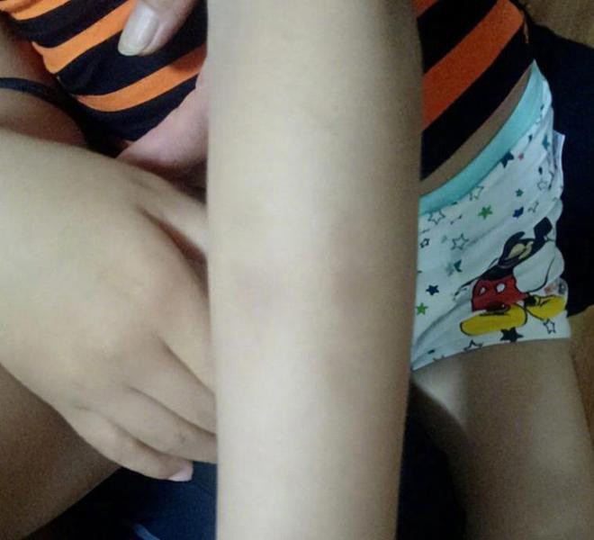 Vết bầm tím trên cơ thể đứa trẻ