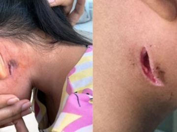 Nhiều người nhiễm vi khuẩn "ăn thịt người", Bộ Y tế ra khuyến cáo