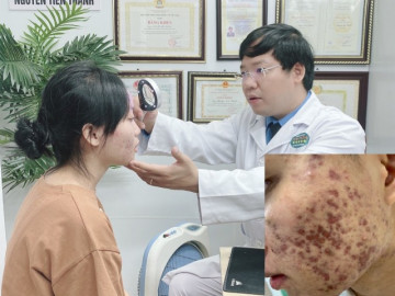 Hãi hùng mặt nữ sinh ở Hà Nội như tổ ong nghìn lỗ sau khi làm đẹp bằng thuốc độc quyền tại Spa