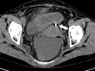 Thủng tử cung vì đặt vòng tránh thai quá lâu