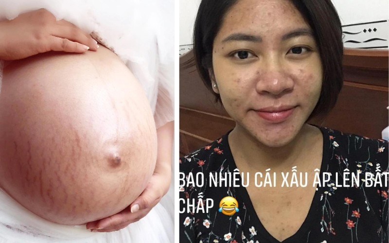 Cựu Hoa hậu cũng không ngại khoe bụng bầu hơn 6 tháng với gương mặt nhiều mụn và những vết rạn đỏ chằng chịt. Vốn sở hữu thân hình gọn gàng nhỏ nhắn nên dù bôi dầu dưỡng từ khi mới mang thai nhưng Đặng Thu Thảo cũng không tránh khỏi tình trạng rạn da.
