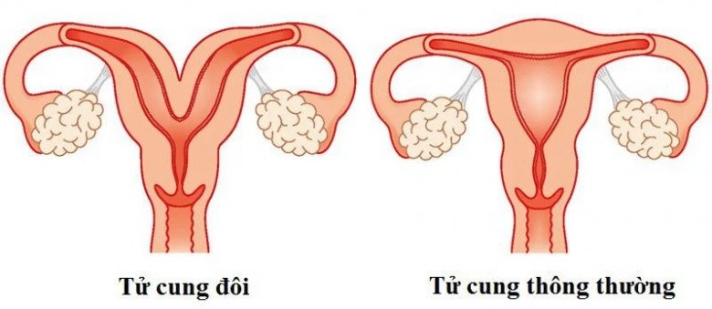 Hình ảnh cho thấy tử cung bình thường và tử cung đôi. Ảnh minh họa.