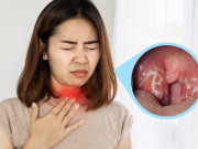 Sức khỏe - Cách hiệu quả nhất để phòng tránh bệnh bạch hầu đang có nguy cơ lan rộng