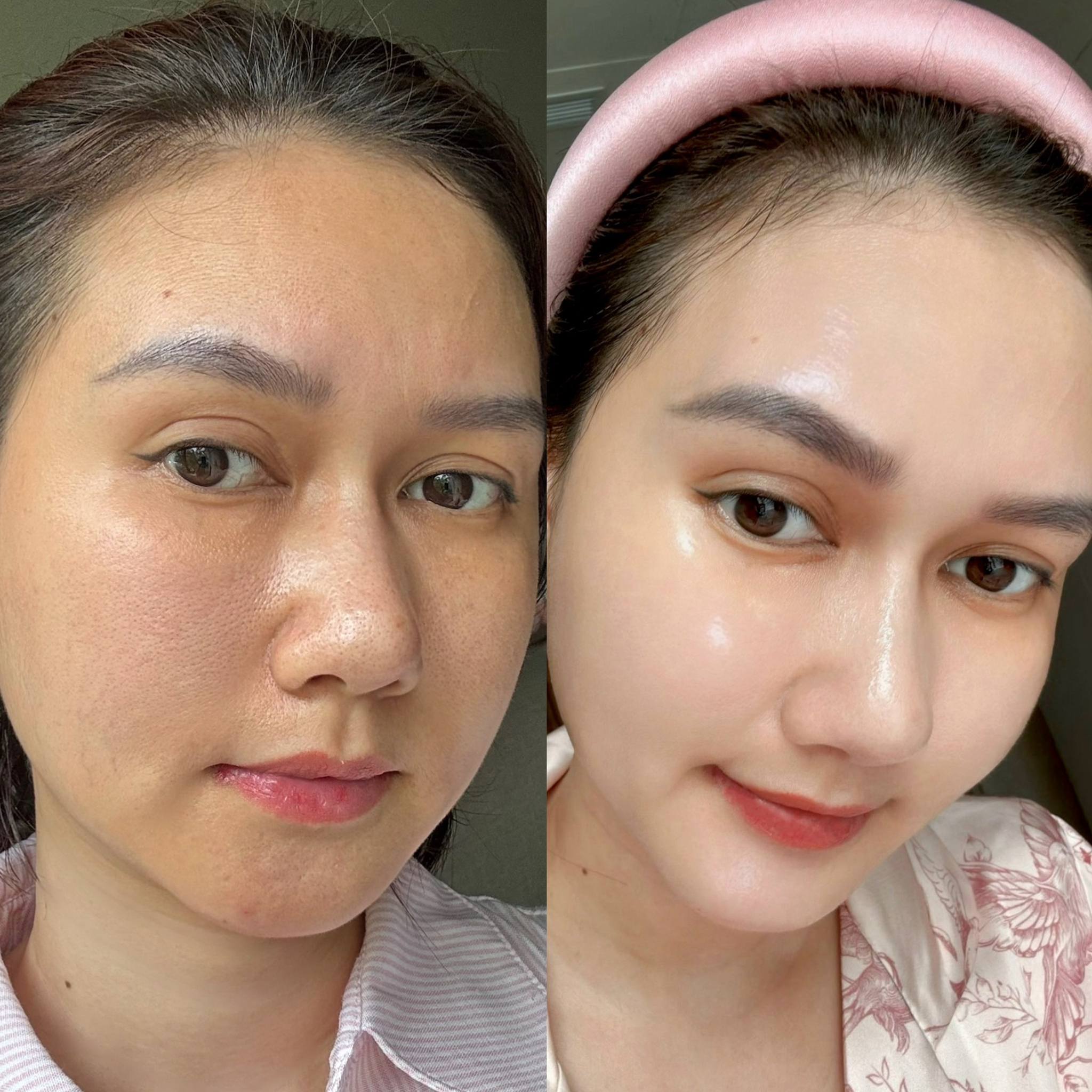 Làn da của mẹ bầu những tháng đầu thai kì.