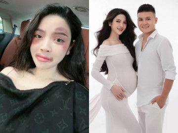 Chu Thanh Huyền vợ Quang Hải bầu sắp vỡ chum bất ngờ lộ ảnh mặt bầm tím khiến dân mạng xôn xao