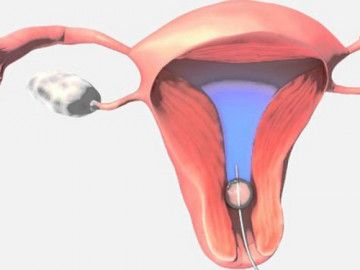 3 dấu hiệu vô sinh ở nữ giới, chị em cần biết