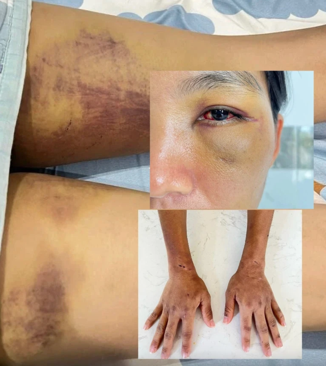 Chị D. bị nhà chồng cũ hành hạ trong một thời gian dài.