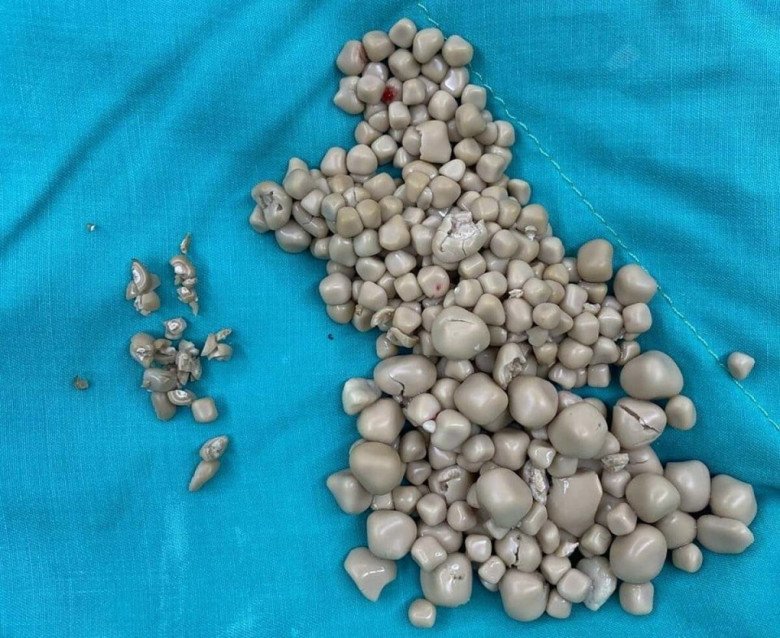 Số sỏi thận tích tục đã lâu được lấy ra từ cơ thể một người bênh. (Ảnh minh họa).