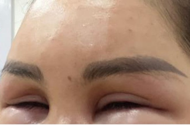 Môi sưng mọng như quả cà chua sau tiêm meso trẻ hóa - 1