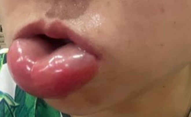 Hình ảnh bệnh nhân trước khi đến khám tại Bệnh viện Da liễu Trung ương.