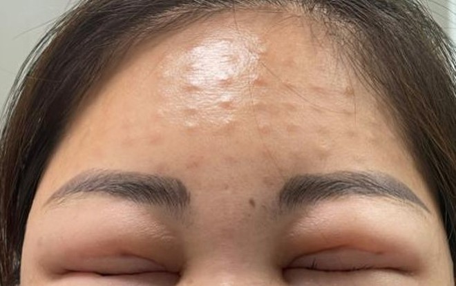 Môi sưng mọng như quả cà chua sau tiêm meso trẻ hóa - 3