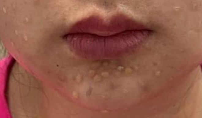 Các tổn thương trên mặt bệnh nhân khi đến Bệnh viện Da liễu Trung ương.