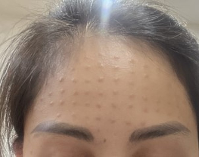 Môi sưng mọng như quả cà chua sau tiêm meso trẻ hóa - 5