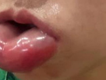 Môi sưng mọng như quả cà chua sau tiêm meso trẻ hóa
