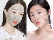 Đẹp - 5 nguyên liệu là "bài thuốc" đánh bay mụn trên da, không tốn tiền đi spa mà hiệu quả vượt trội