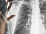 Sức khỏe - Mắc ung thư phổi giai đoạn cuối, người đàn ông vẫn chữa khỏi bệnh, sống khỏe mạnh 6 năm nhờ làm điều này