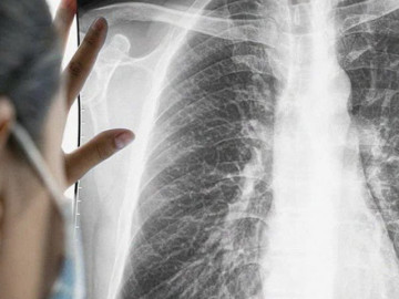 Mắc ung thư phổi giai đoạn cuối, người đàn ông vẫn chữa khỏi bệnh, sống khỏe mạnh 6 năm nhờ làm điều này