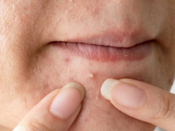 Các bước chăm sóc da sau khi nặn mụn để hết thâm