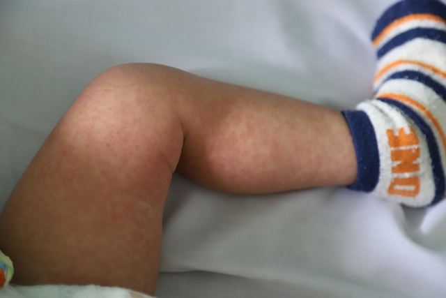 Các vết ban trên chân của trẻ mắc bệnh sởi. Ảnh: Phạm Thương.