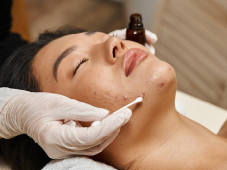 Dùng các sản phẩm trị mụn trứng cá cần lưu ý gì?