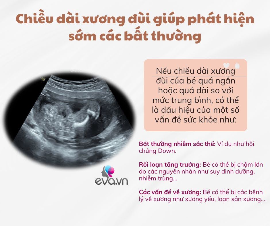 Chân con có dài như siêu mẫu hay không, mẹ cần biết rõ 4 yếu tố ảnh hưởng đến chiều dài xương đùi của thai nhi - 4