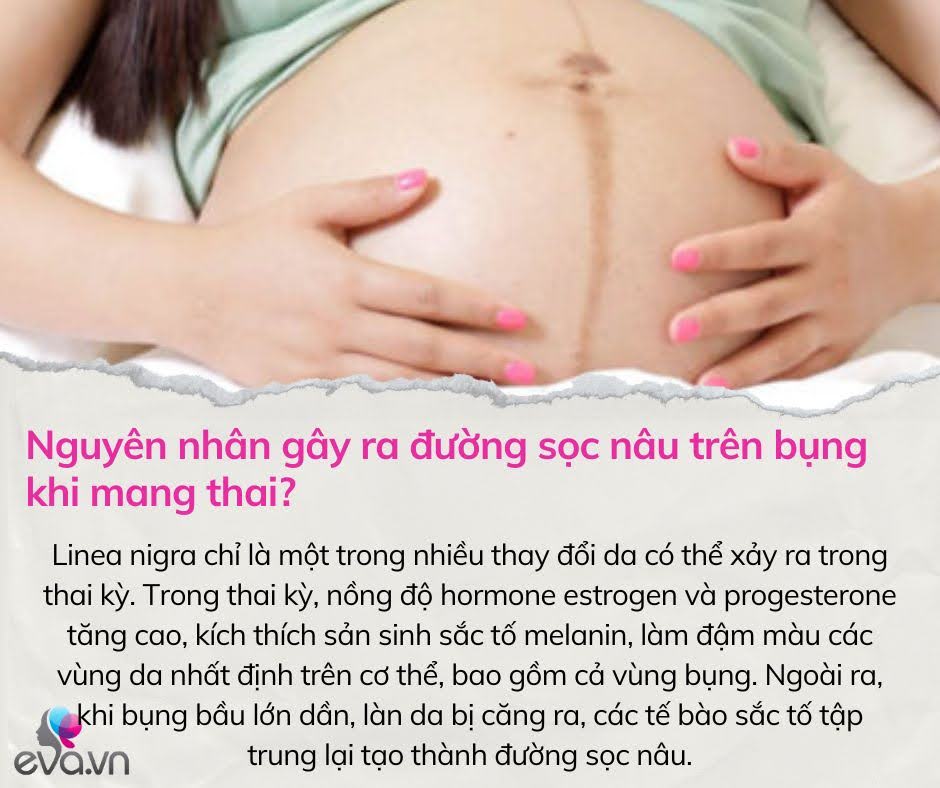 Mang thai bé đầu lòng, mẹ bầu hốt hoảng khi thấy một vệt nâu chạy dài trên bụng, các bác sĩ nói gì? - 3