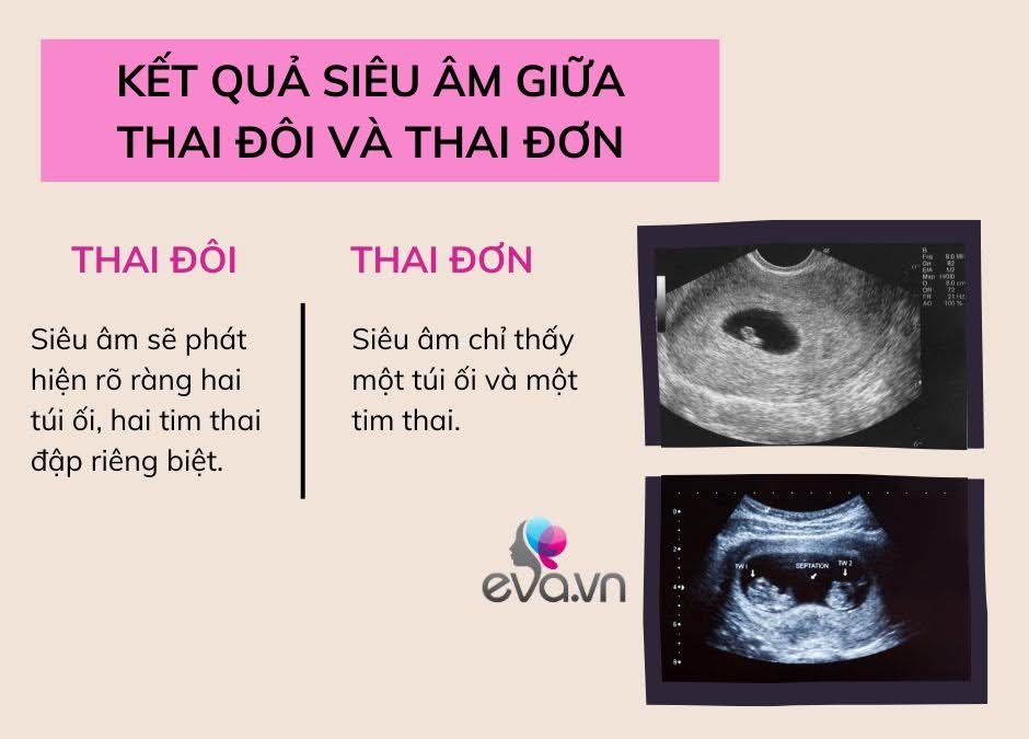 Mang thai đôi khác với thai đơn như thế nào? Có thể phát hiện thai đôi qua que thử thai không? - 5