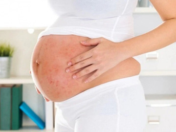 Phụ nữ mang thai cần làm gì khi mắc sởi?