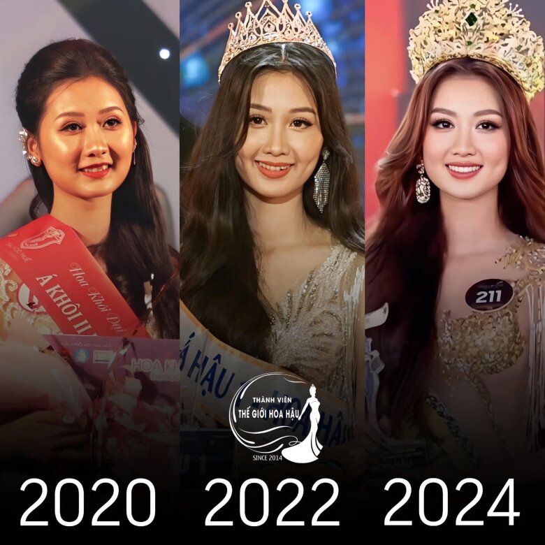 Tân Miss Grand Vietnam 2024 chỉnh răng để đẹp hoàn mỹ hơn.